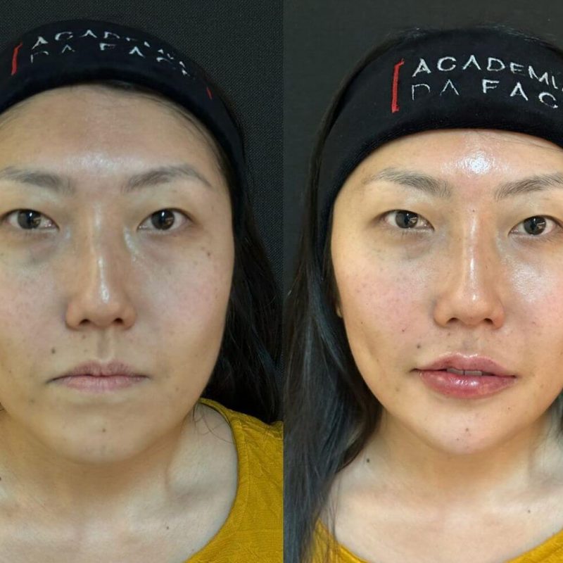 paciente 01 (malar anterior, nariz, mento, boca, abertura piriforme 8 ml) - 3